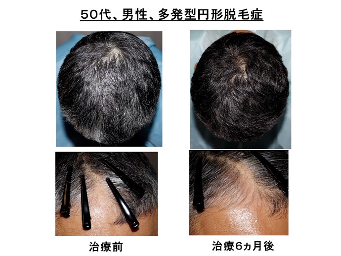 円形脱毛症　病院
